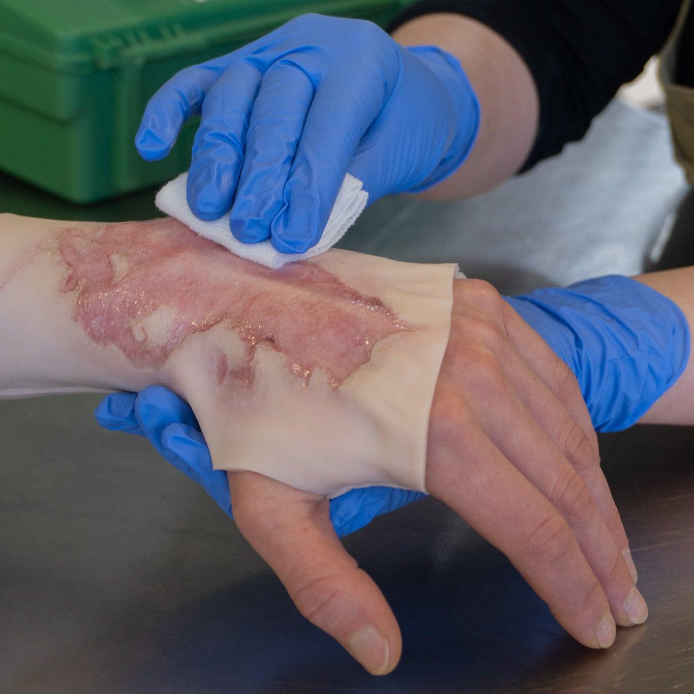 2nd Degree Burn