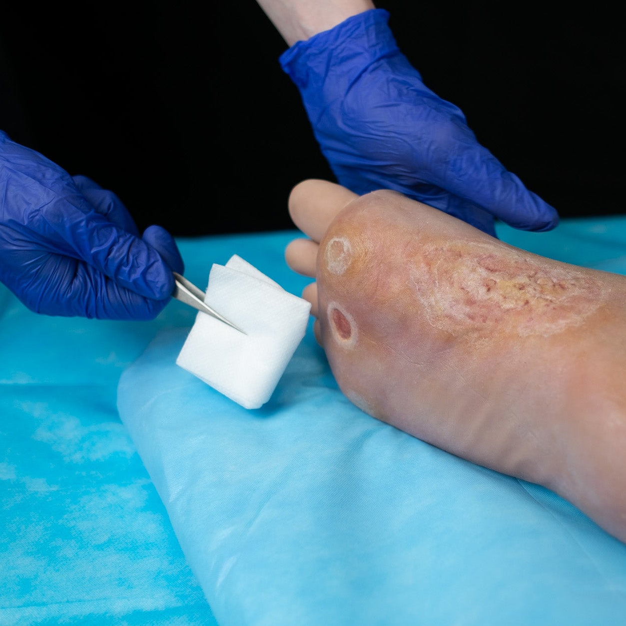 Diabetic Ulcer