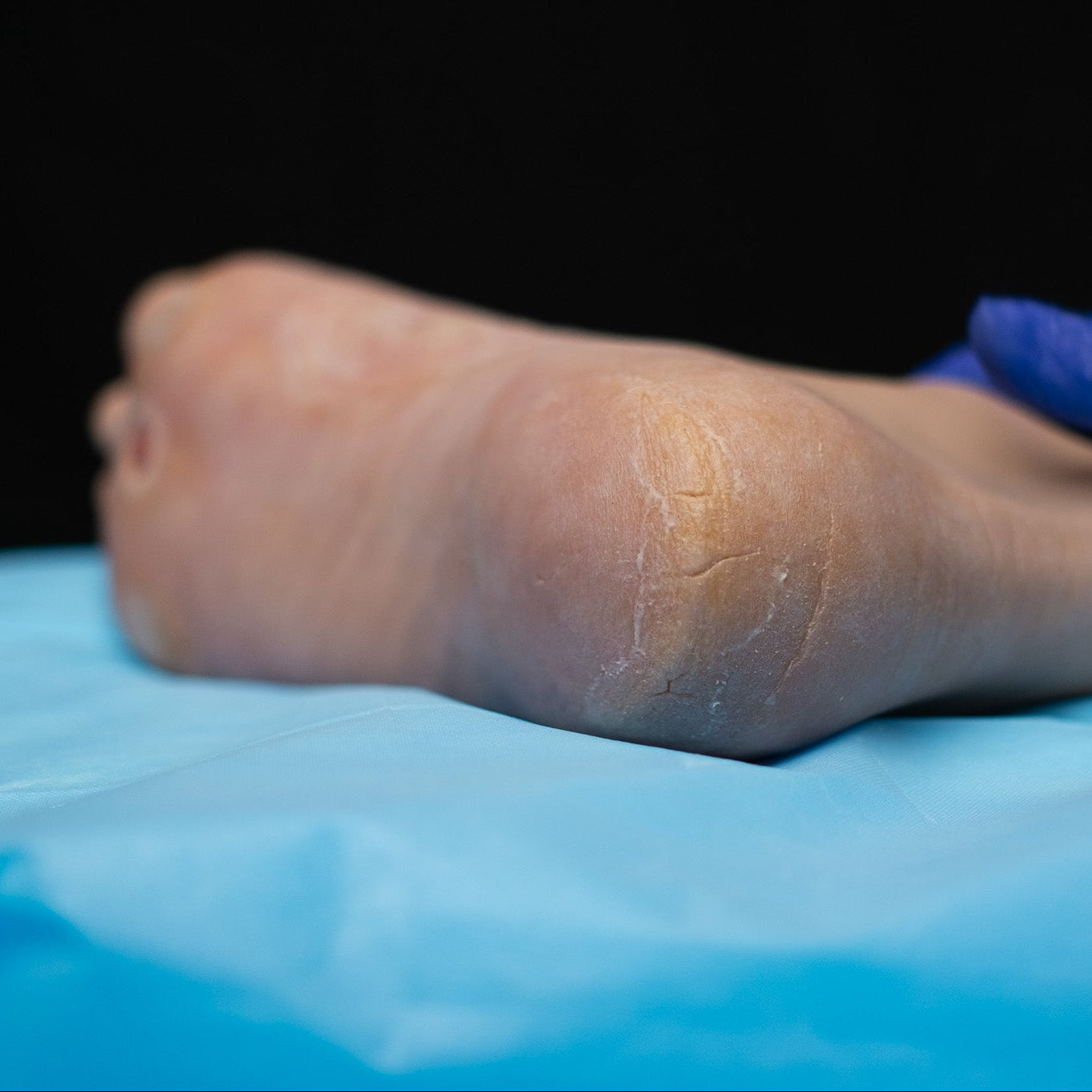 Diabetic Ulcer