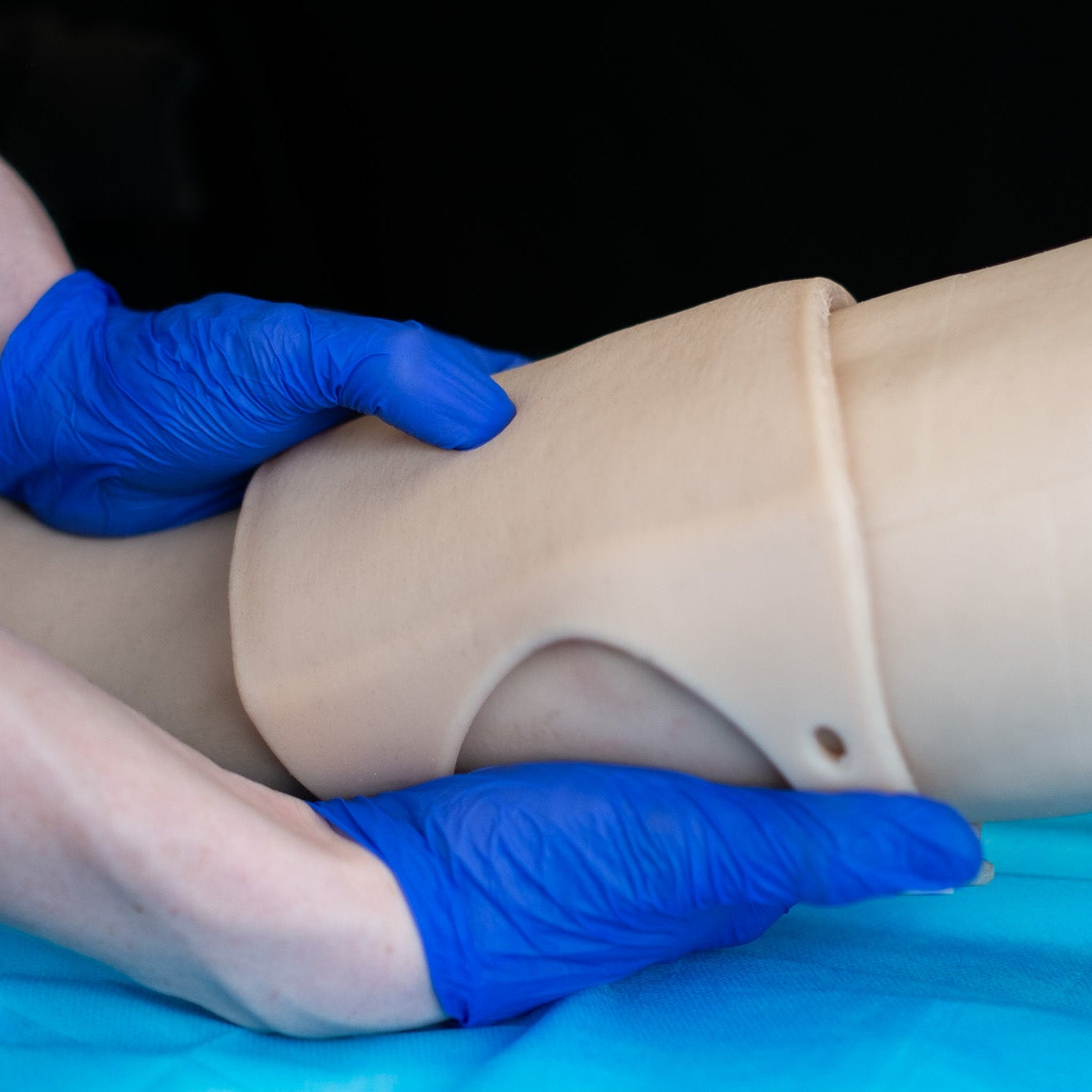 Pitting Edema