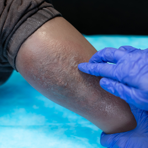Cellulitis
