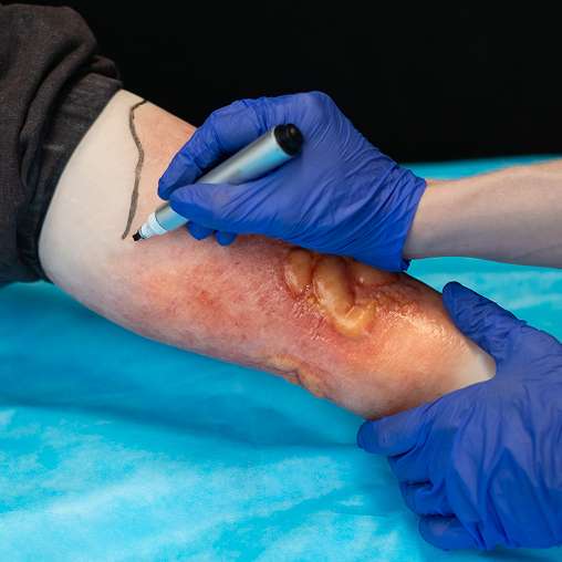 Cellulitis