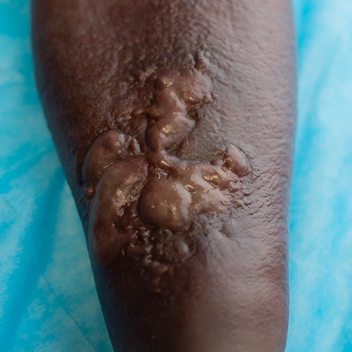 Cellulitis